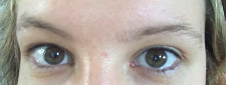 Avis Bi-Oil sur les cicatrices d'acné Avis Bi-Oil sur les cicatrices d'acné