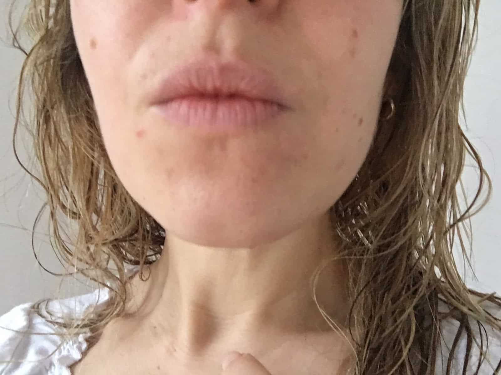 Avis Bi-Oil sur les cicatrices d'acné Avis Bi-Oil sur les cicatrices d'acné