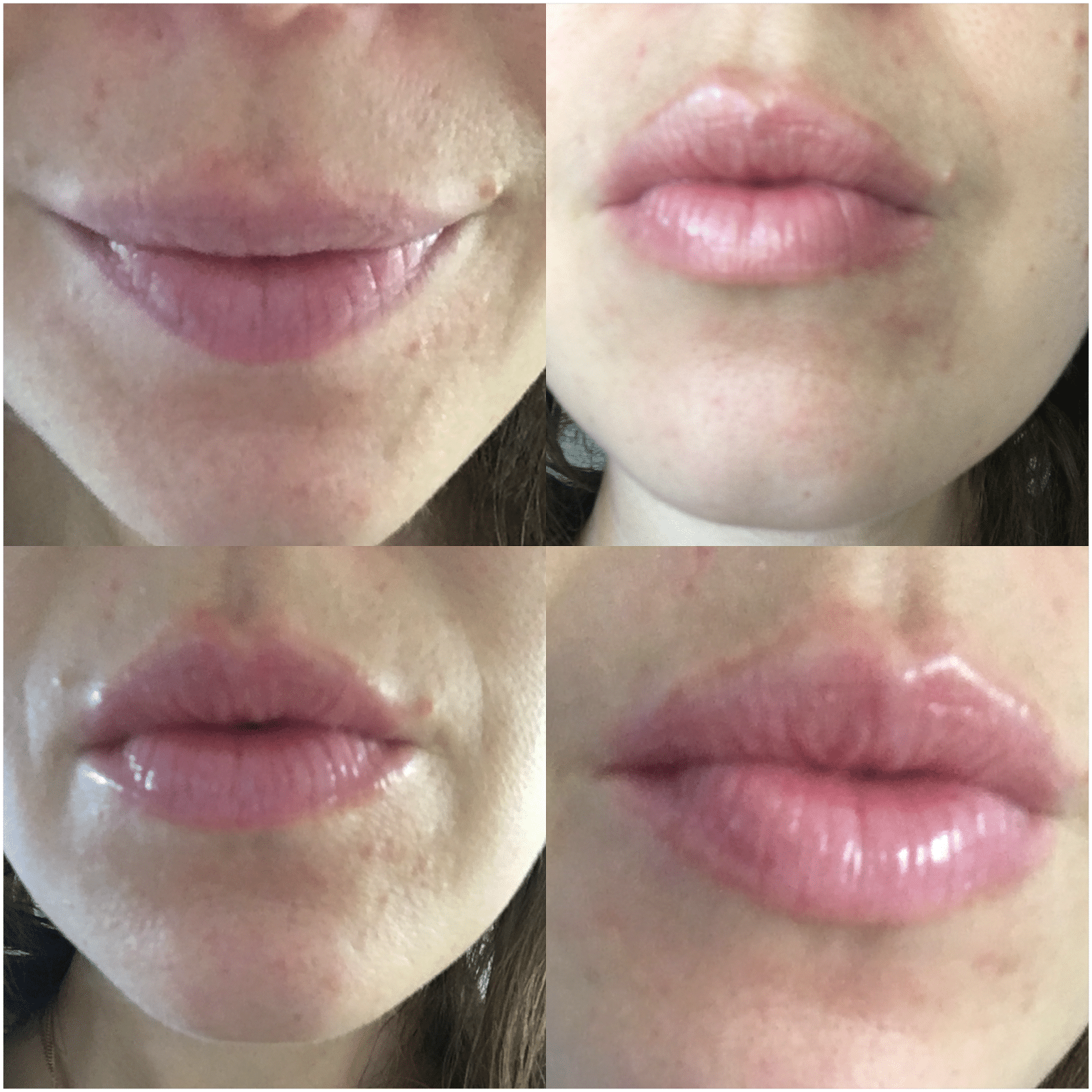 lip volume xpress Biosmose stick volume levre comme injection 