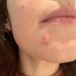 acné hormonal peau adulte