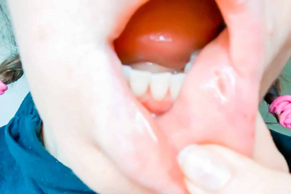 comment soulager un aphte dans la bouche rapidement