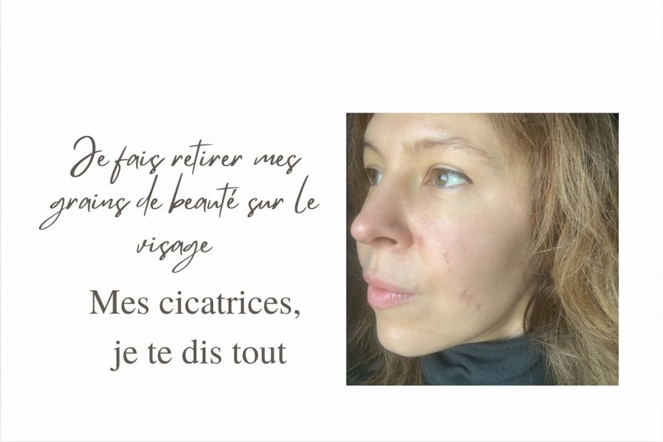 photo cicatrices retrait grains de beauté sur le visage avant après