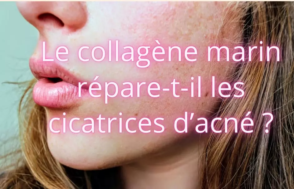 Le collagène marin répare-t-il les cicatrices d’acné ?