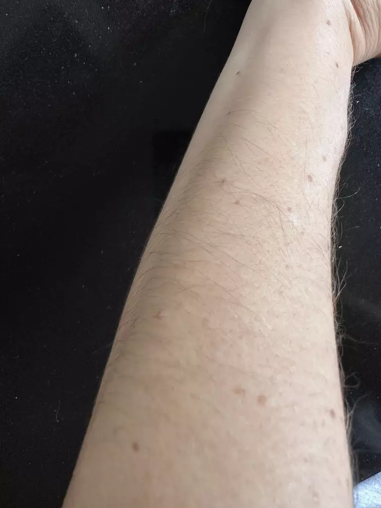 avant après décoloration poils de bras