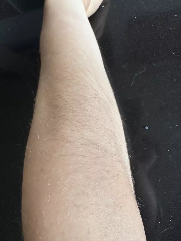 avant après décoloration poils de bras