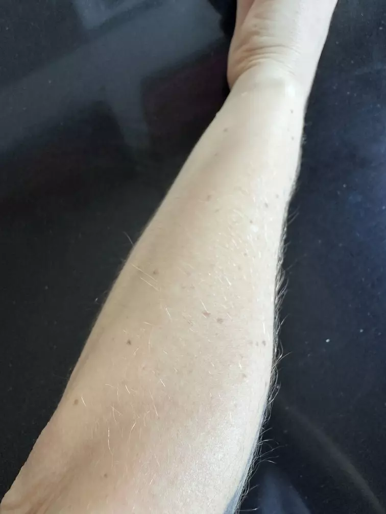 avant après décoloration poils de bras
